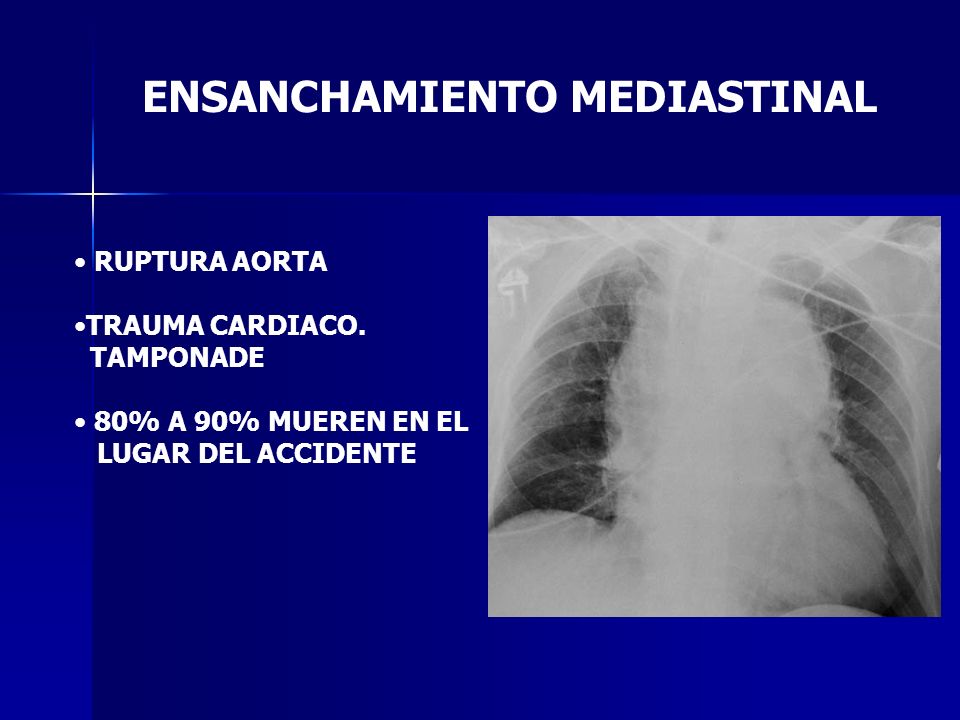 Ensanchamiento mediastinal pdf to word